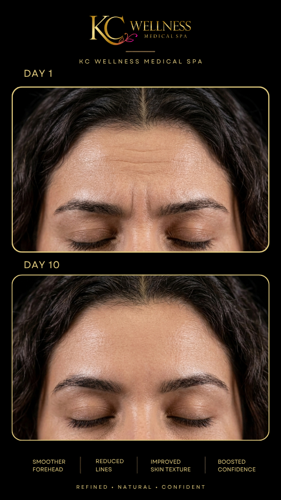 Day 1 after Botox