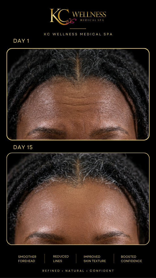 Day 7 after Botox